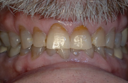 Intraoral photo of front teeth showing dental work with color variation and gum margins