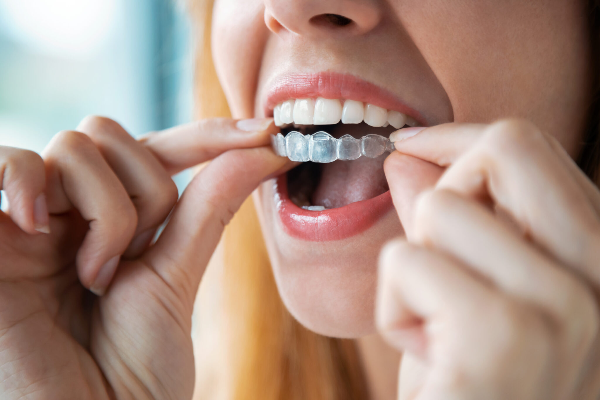How Does Invisalign Move Teeth? The Science Behind the Smile - Lumiere ...