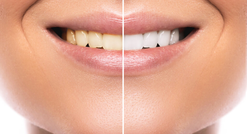 Close up of female mouth. Comparison after teeth whitening