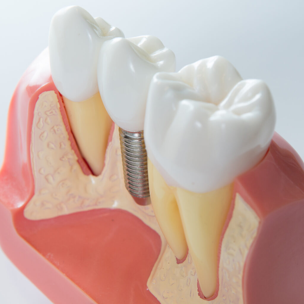 Close up of a Dental implant model. Selective focus.